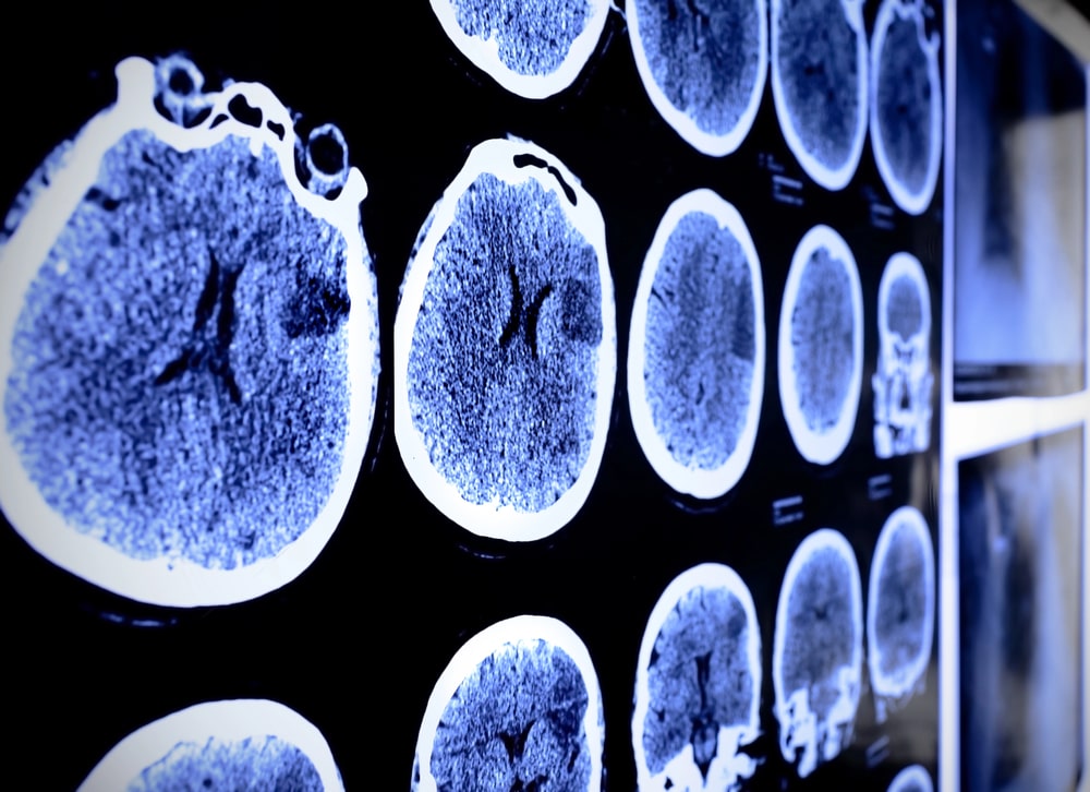 Traumatic Brain Injuries in Florida Personal Injury Cases - Jacobson Injury Firm