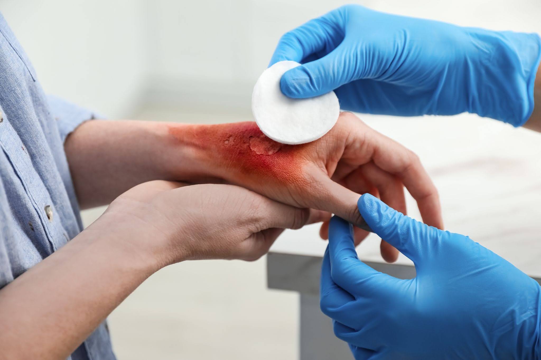 Coral Springs burn injury attorney