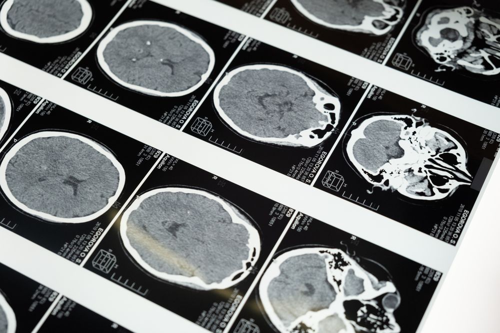 Traumatic Brain Injury (TBI) Lawyer Boca Raton, FL