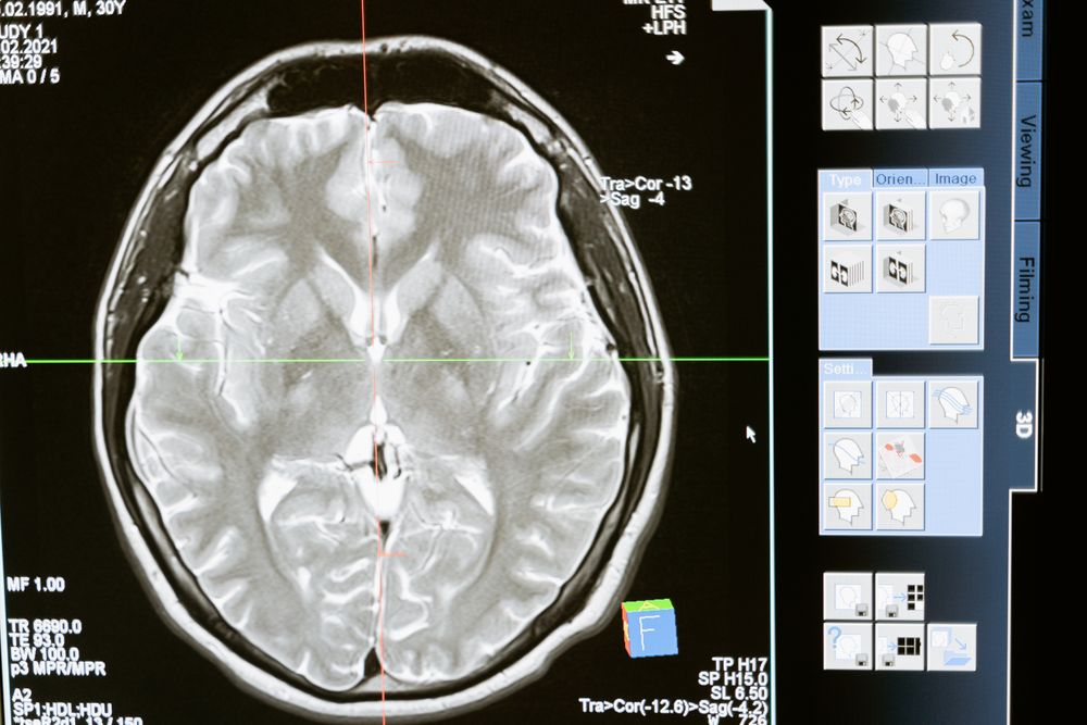 Traumatic Brain Injury (TBI) Lawyer Chicago, IL